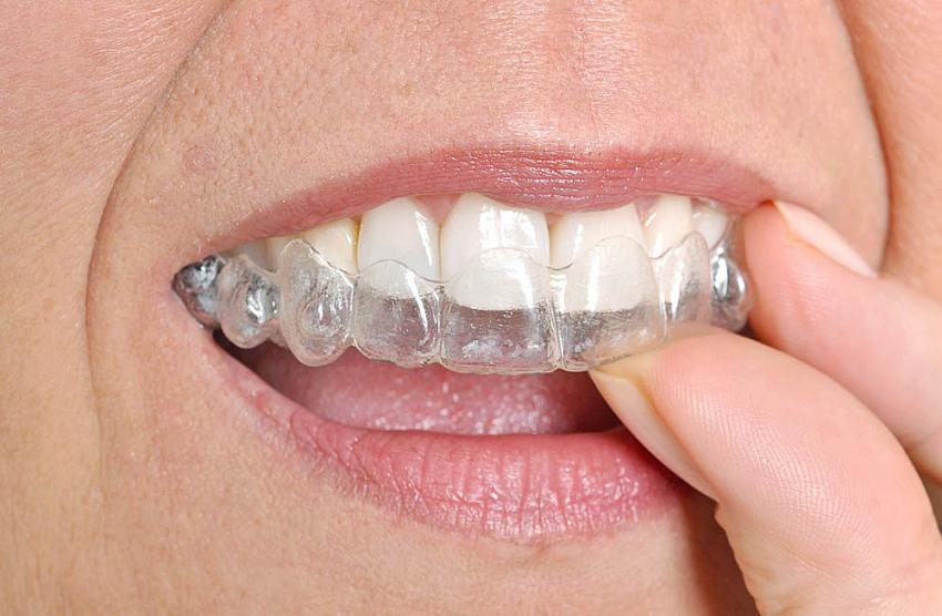 Ortodontik Tedavi ile Diş Estetiği